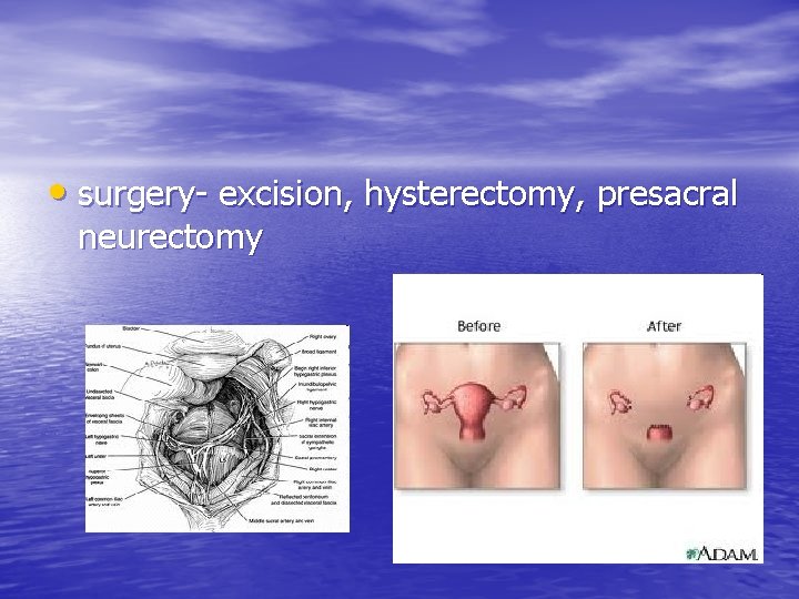  • surgery- excision, hysterectomy, presacral neurectomy 