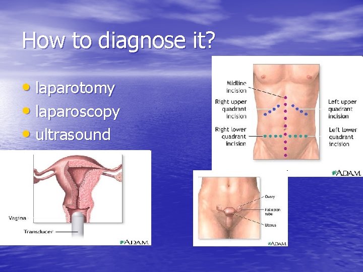 How to diagnose it? • laparotomy • laparoscopy • ultrasound 