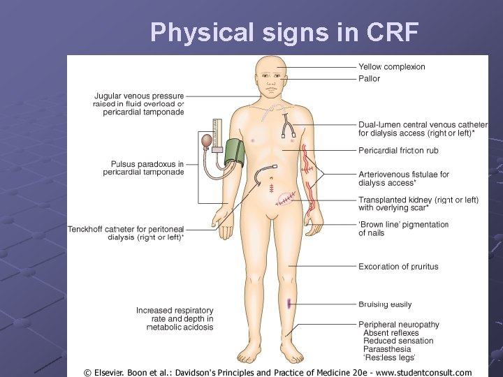 Physical signs in CRF 