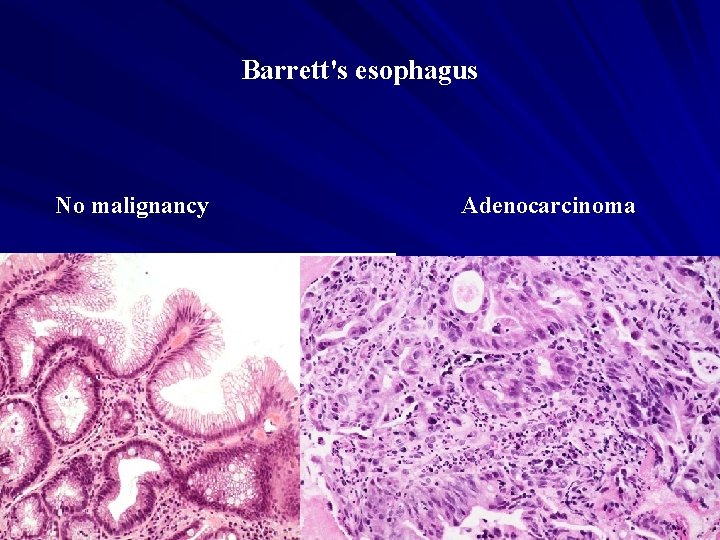 Barrett's esophagus No malignancy Adenocarcinoma 