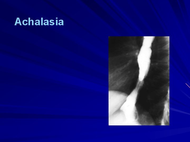 Achalasia 