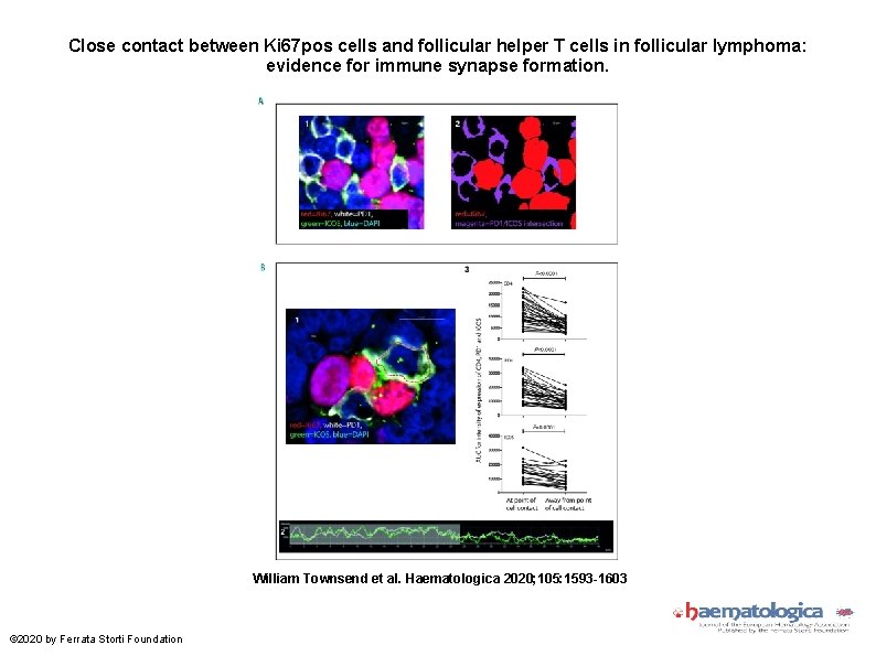 Close contact between Ki 67 pos cells and follicular helper T cells in follicular