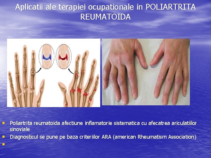 Aplicatii ale terapiei ocupationale in POLIARTRITA REUMATOIDA • Poliartrita reumatoida afectiune inflamatorie sistematica cu