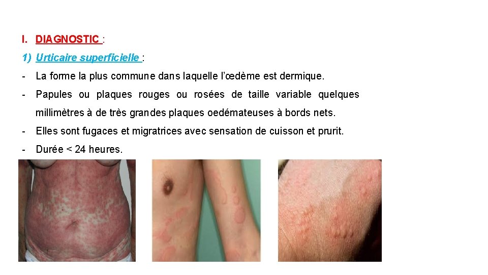 I. DIAGNOSTIC : 1) Urticaire superficielle : - La forme la plus commune dans