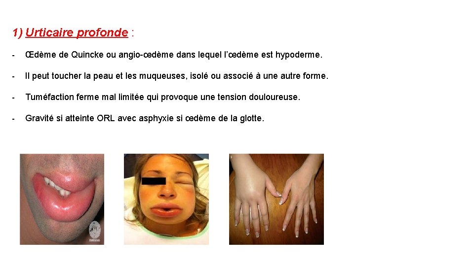 1) Urticaire profonde : - Œdème de Quincke ou angio-œdème dans lequel l’œdème est