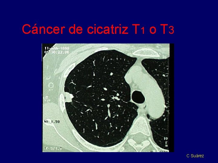 Cáncer de cicatriz T 1 o T 3 C Suárez 