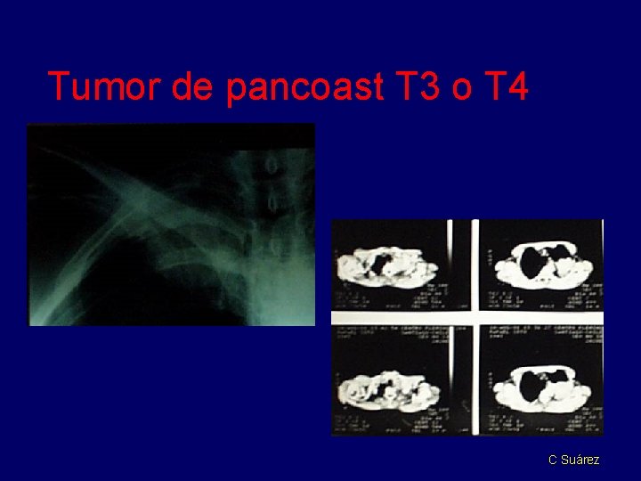 Tumor de pancoast T 3 o T 4 C Suárez 