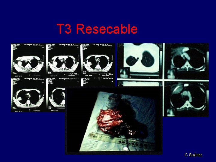 T 3 Resecable C Suárez 