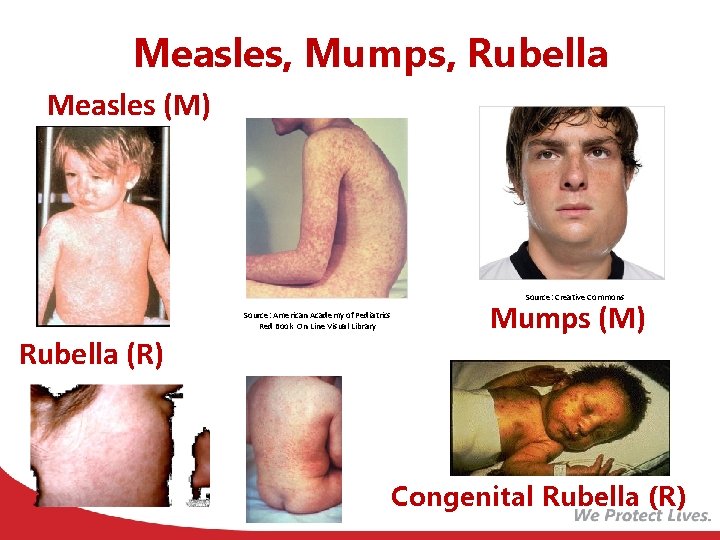 Measles, Mumps, Rubella Measles (M) Source: Creative Commons Source: American Academy of Pediatrics Red