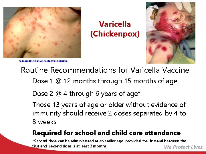 Varicella (Chickenpox) © Copyright American Academy of Pediatrics Routine Recommendations for Varicella Vaccine •