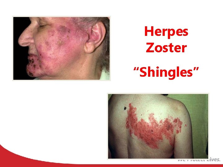 Herpes Zoster “Shingles” 