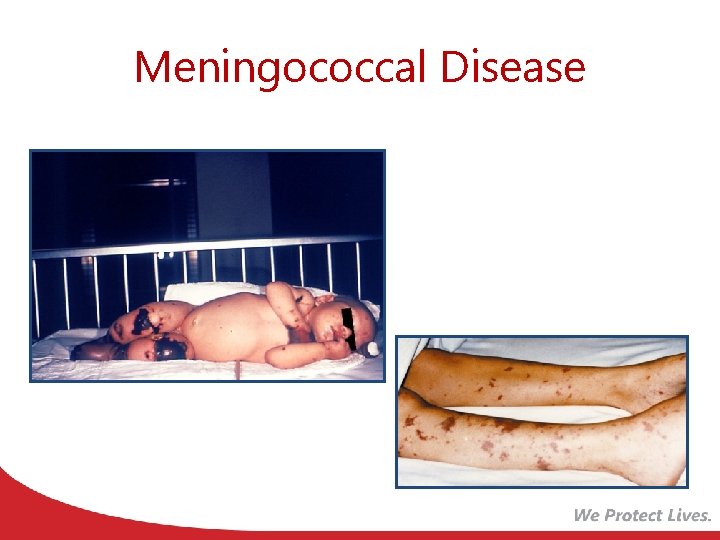 Meningococcal Disease 