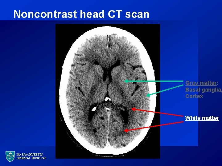 Noncontrast head CT scan Gray matter: Basal ganglia, Cortex White matter MASSACHUSETTS GENERAL HOSPITAL