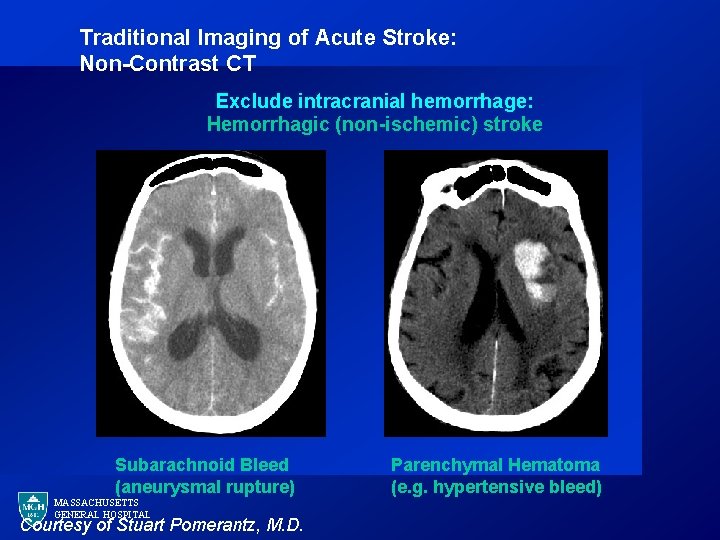 Traditional Imaging of Acute Stroke: Non-Contrast CT Exclude intracranial hemorrhage: Hemorrhagic (non-ischemic) stroke Subarachnoid