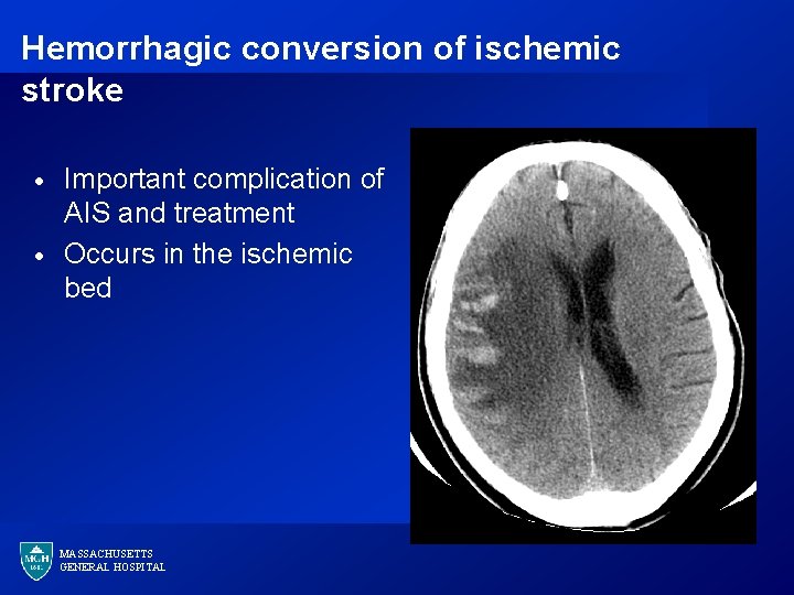 Hemorrhagic conversion of ischemic stroke · · Important complication of AIS and treatment Occurs