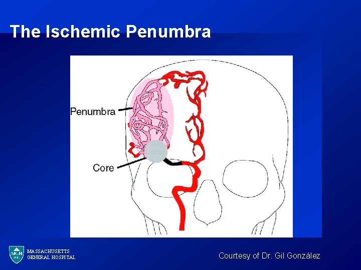 The Ischemic Penumbra MASSACHUSETTS GENERAL HOSPITAL Courtesy of Dr. Gil González 
