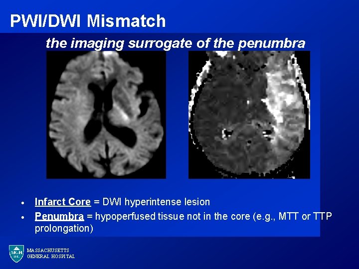 PWI/DWI Mismatch the imaging surrogate of the penumbra · · Infarct Core = DWI