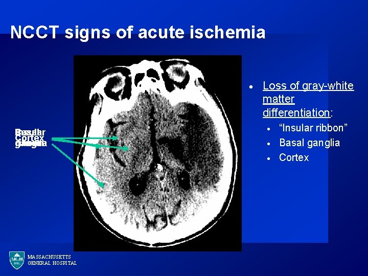 NCCT signs of acute ischemia · Basal Insular Cortex ganglia ribbon Loss of gray-white