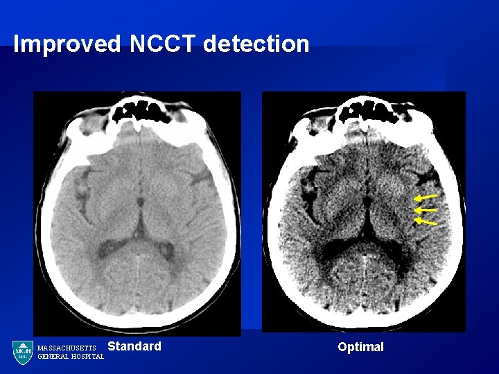 Improved NCCT detection MASSACHUSETTS GENERAL HOSPITAL Standard Optimal 