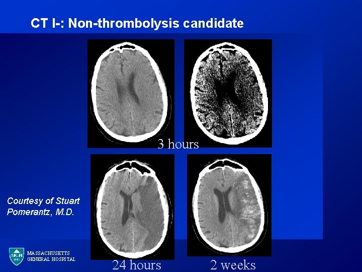 CT I-: Non-thrombolysis candidate 3 hours Courtesy of Stuart Pomerantz, M. D. MASSACHUSETTS GENERAL