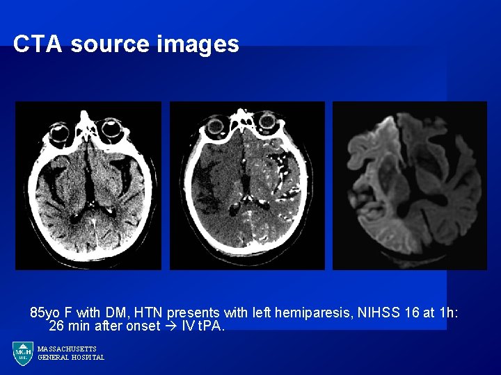 CTA source images MGH 85 yo F with DM, HTN presents with left hemiparesis,