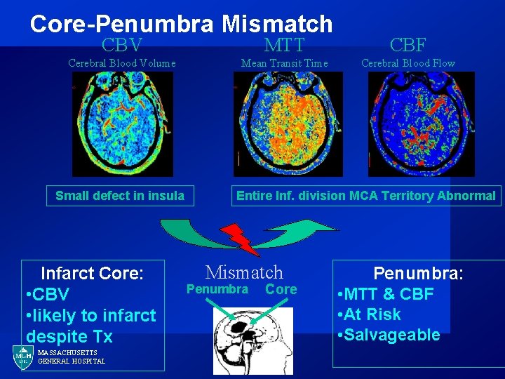 Core-Penumbra Mismatch CBV MTT CBF Cerebral Blood Volume Mean Transit Time Cerebral Blood Flow