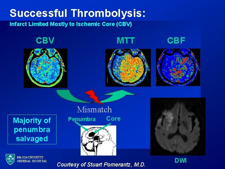 Successful Thrombolysis: Infarct Limited Mostly to Ischemic Core (CBV) CBV MTT CBF Mismatch Majority