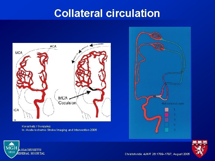Collateral circulation Koroshetz / Gonzalez In : Acute Ischemic Stroke Imaging and Intervention 2006