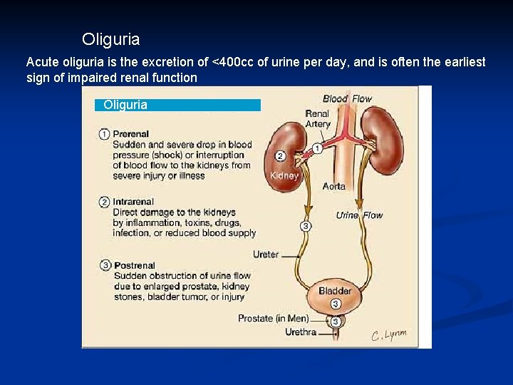 Oliguria Acute oliguria is the excretion of <400 cc of urine per day, and