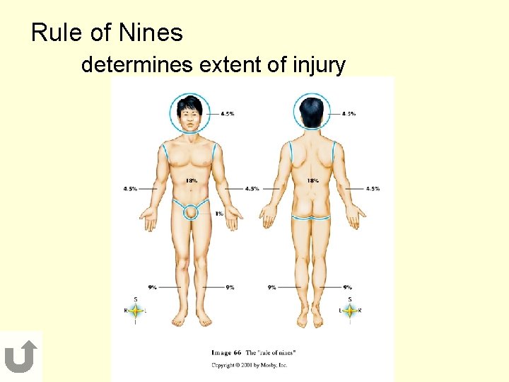 Rule of Nines determines extent of injury 