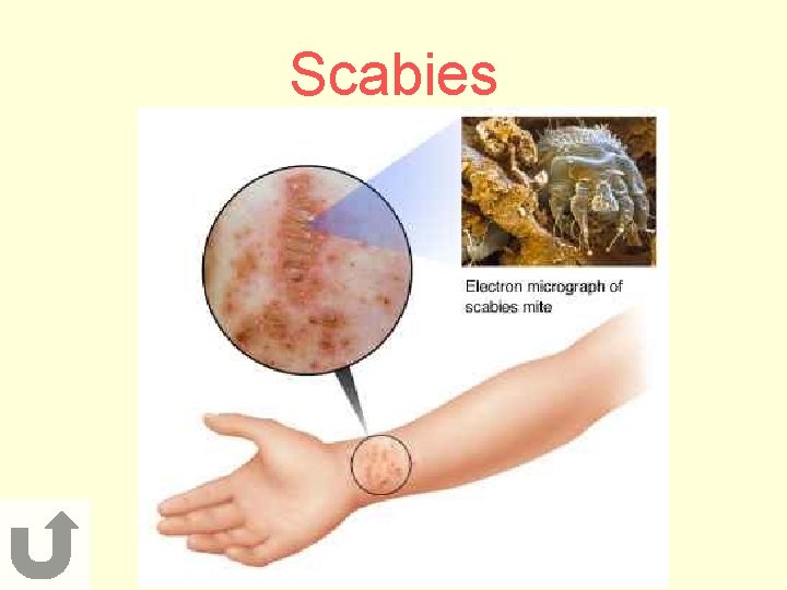 Scabies 