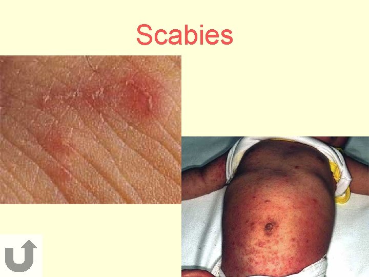 Scabies 