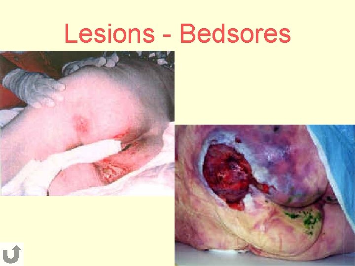 Lesions - Bedsores 