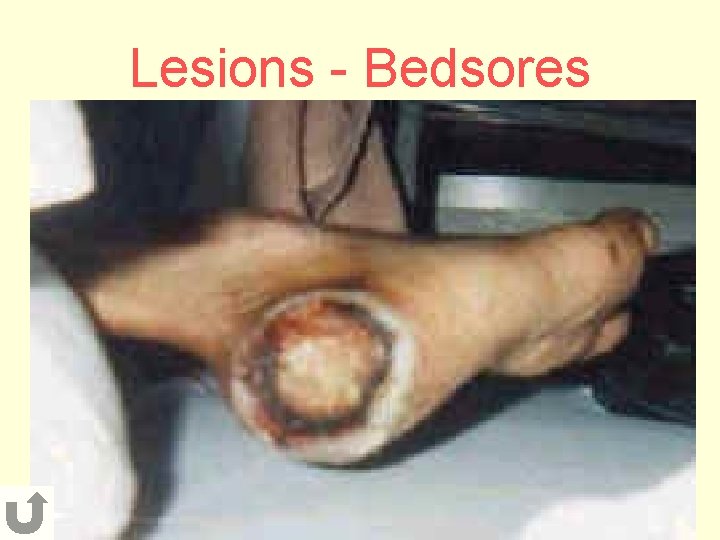 Lesions - Bedsores 