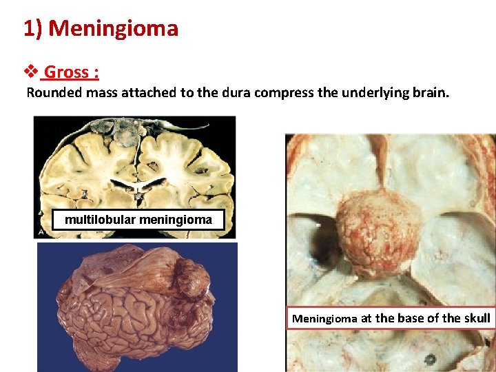 1) Meningioma v Gross : Rounded mass attached to the dura compress the underlying