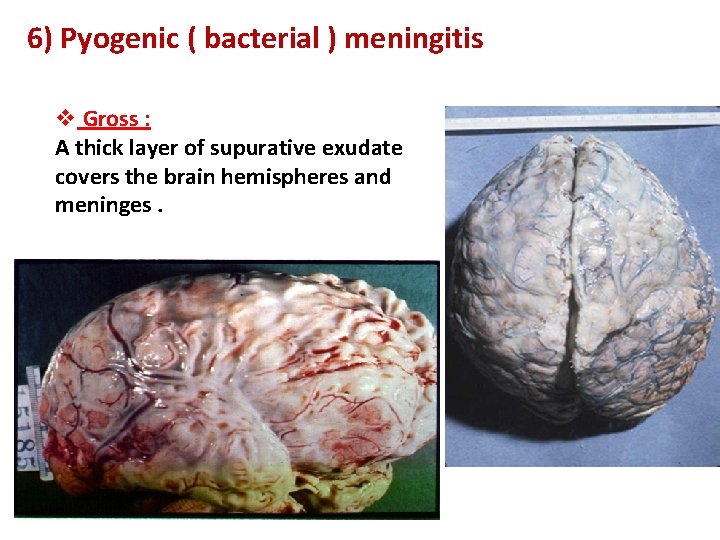 6) Pyogenic ( bacterial ) meningitis v Gross : A thick layer of supurative