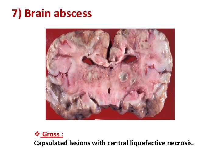 7) Brain abscess v Gross : Capsulated lesions with central liquefactive necrosis. 