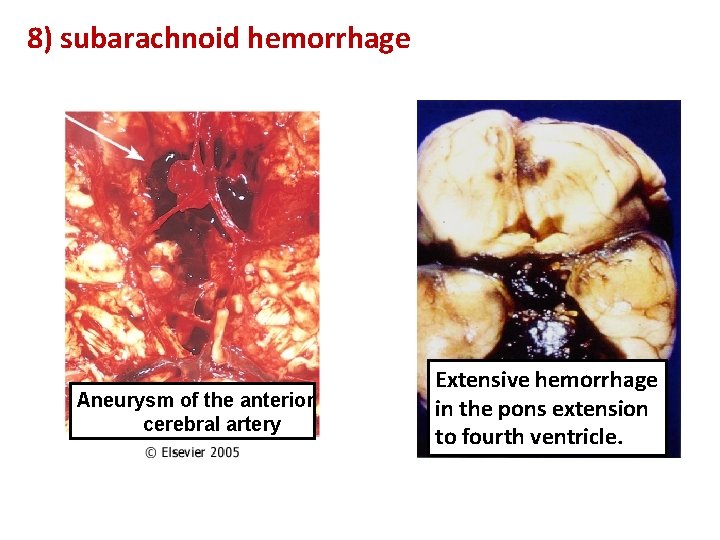 8) subarachnoid hemorrhage Aneurysm of the anterior cerebral artery Extensive hemorrhage in the pons
