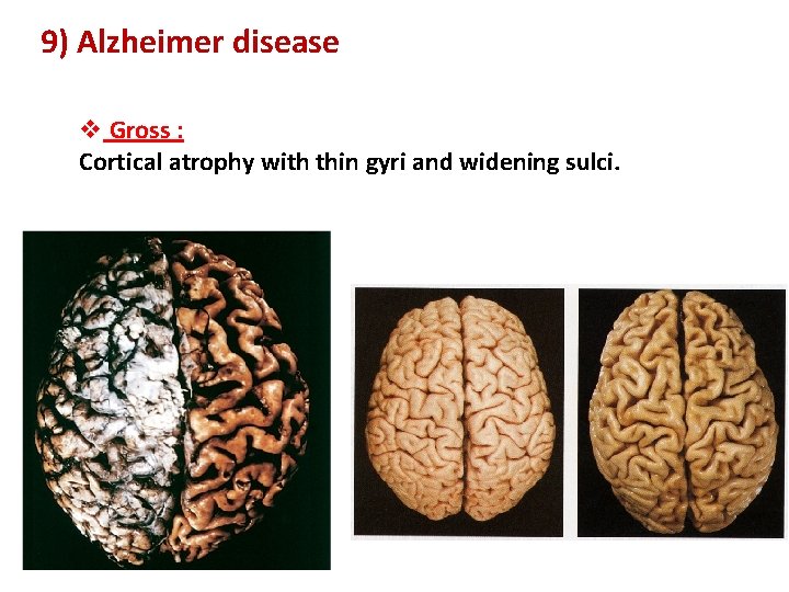 9) Alzheimer disease v Gross : Cortical atrophy with thin gyri and widening sulci.