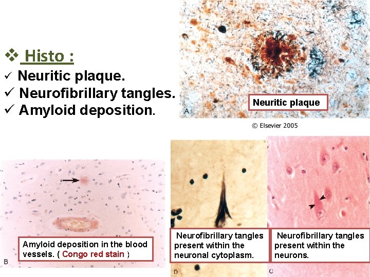 v Histo : Neuritic plaque. ü Neurofibrillary tangles. ü Amyloid deposition in the blood