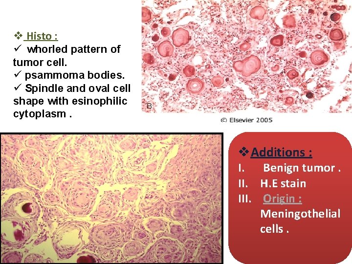 v Histo : ü whorled pattern of tumor cell. ü psammoma bodies. ü Spindle