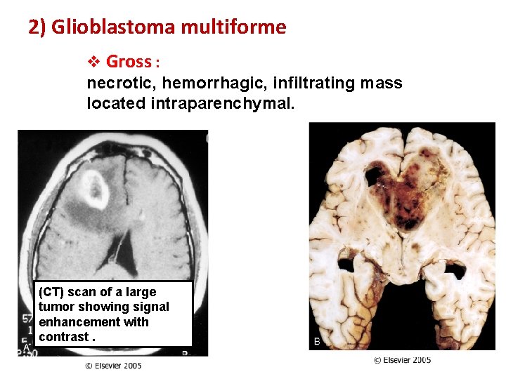 2) Glioblastoma multiforme v Gross : necrotic, hemorrhagic, infiltrating mass located intraparenchymal. (CT) scan