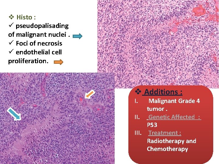 v Histo : ü pseudopalisading of malignant nuclei. ü Foci of necrosis ü endothelial
