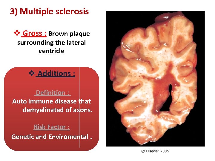 3) Multiple sclerosis v Gross : Brown plaque surrounding the lateral ventricle v Additions