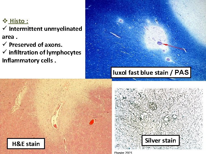 v Histo : ü Intermittent unmyelinated area. ü Preserved of axons. ü infiltration of