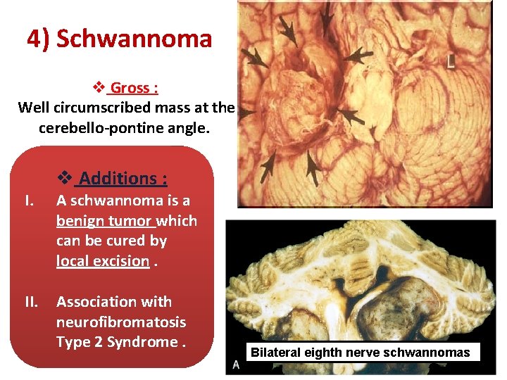 4) Schwannoma v Gross : Well circumscribed mass at the cerebello-pontine angle. II. v