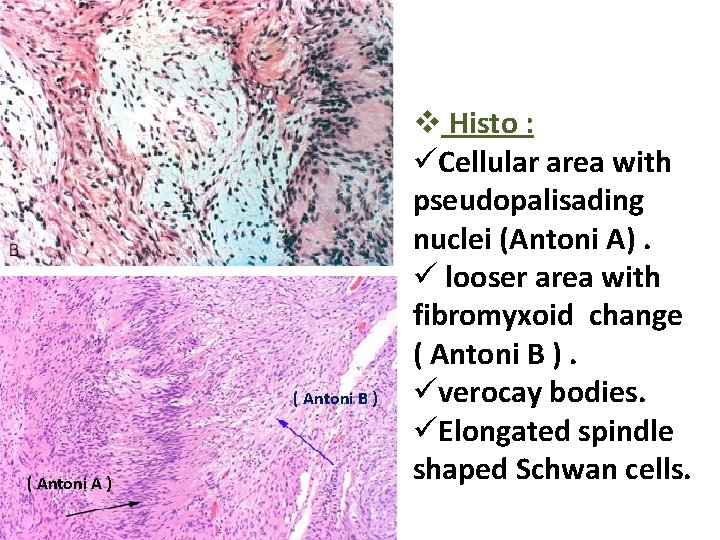 ( Antoni B ) ( Antoni A ) v Histo : üCellular area with