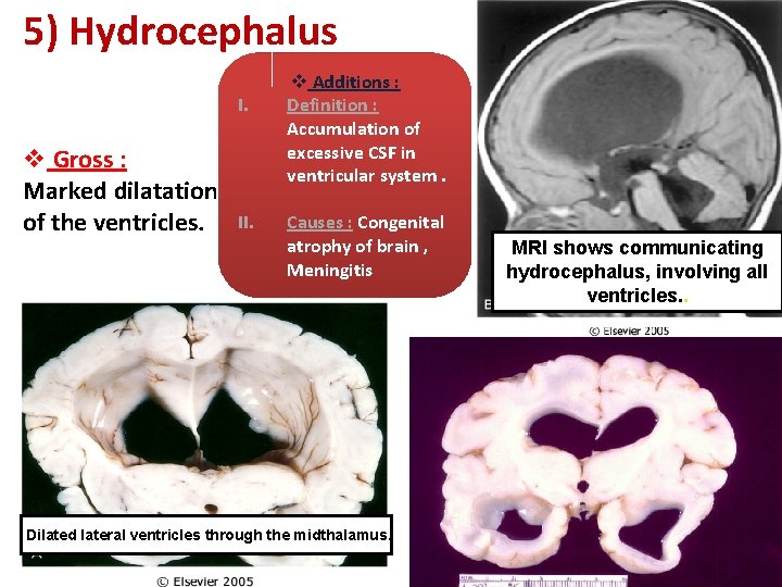 5) Hydrocephalus I. v Gross : Marked dilatation of the ventricles. II. v Additions
