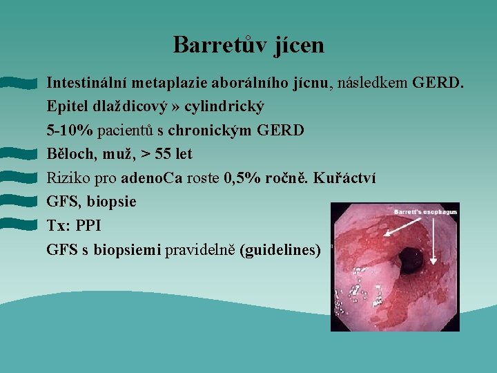 Barretův jícen Intestinální metaplazie aborálního jícnu, následkem GERD. Epitel dlaždicový » cylindrický 5 -10%