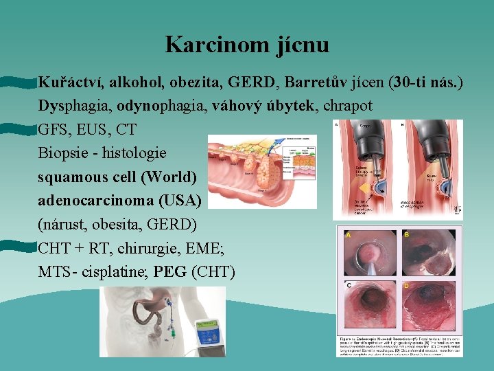 Karcinom jícnu Kuřáctví, alkohol, obezita, GERD, Barretův jícen (30 -ti nás. ) Dysphagia, odynophagia,